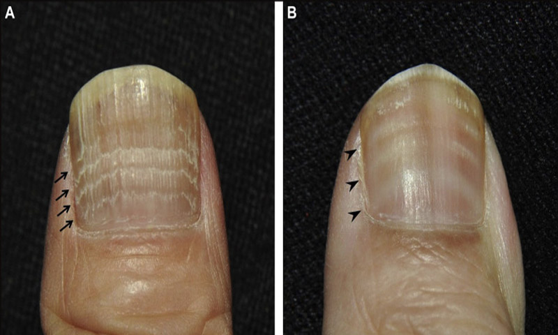 Do Vitamin Deficiencies Cause Fingernail Ridges? | livestrong