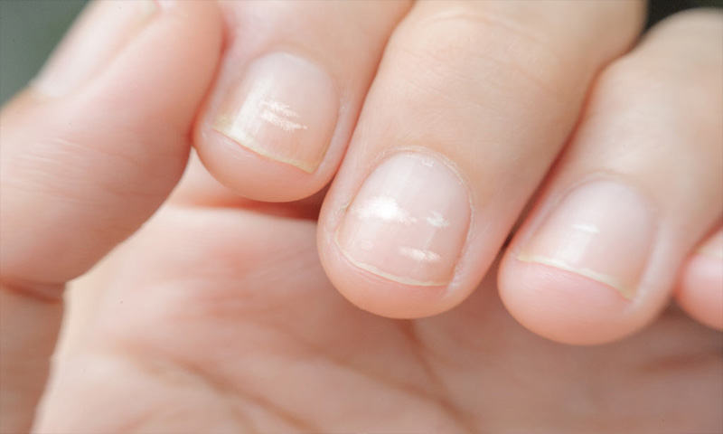 What do your Nails Say about your Health