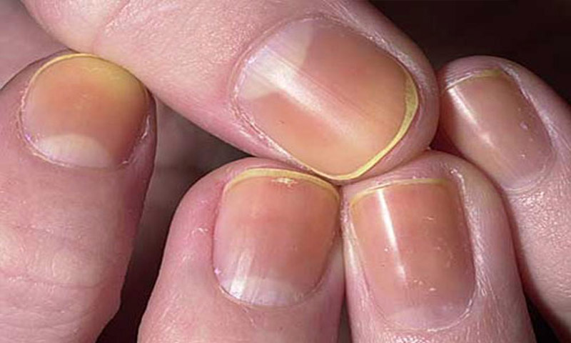 What do your Nails Say about your Health