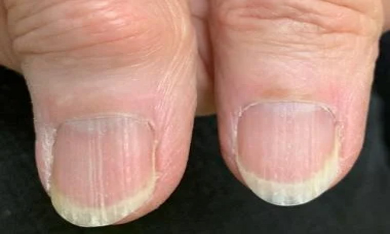 What Do Your Nails Say About Your Health? - wide 1